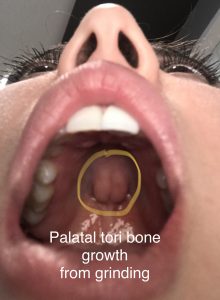 Palatal Tori bone